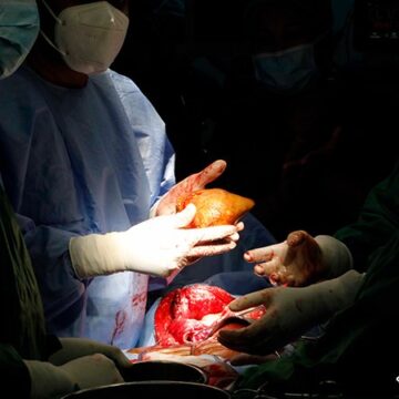 Cea mai mare piatră la rinichi din lume, îndepărtată chirurgical de medici din Sri Lanka FOTO