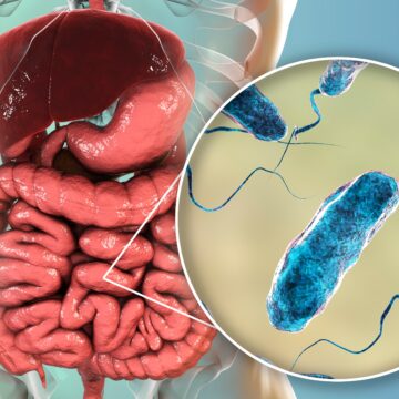 Ce este holera, ce simptome are și cum se transmite boala care a dispărut de 30 de ani din România