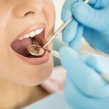 Gutierele invizibile. Ce avantaje au față de aparatele dentare fixe