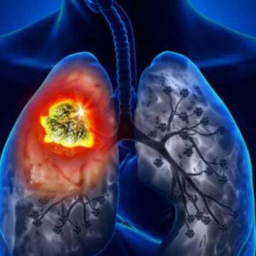 Ce persoane sunt afectate cel mai frecvent de cancerul la plămâni