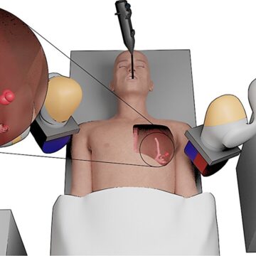 cancer.jpg VIDEO. Cancerul pulmonar, tratat de un mini robot. Cum arată dispozitivul dezvoltat de cercetătorii de la Universitatea din Leeds
