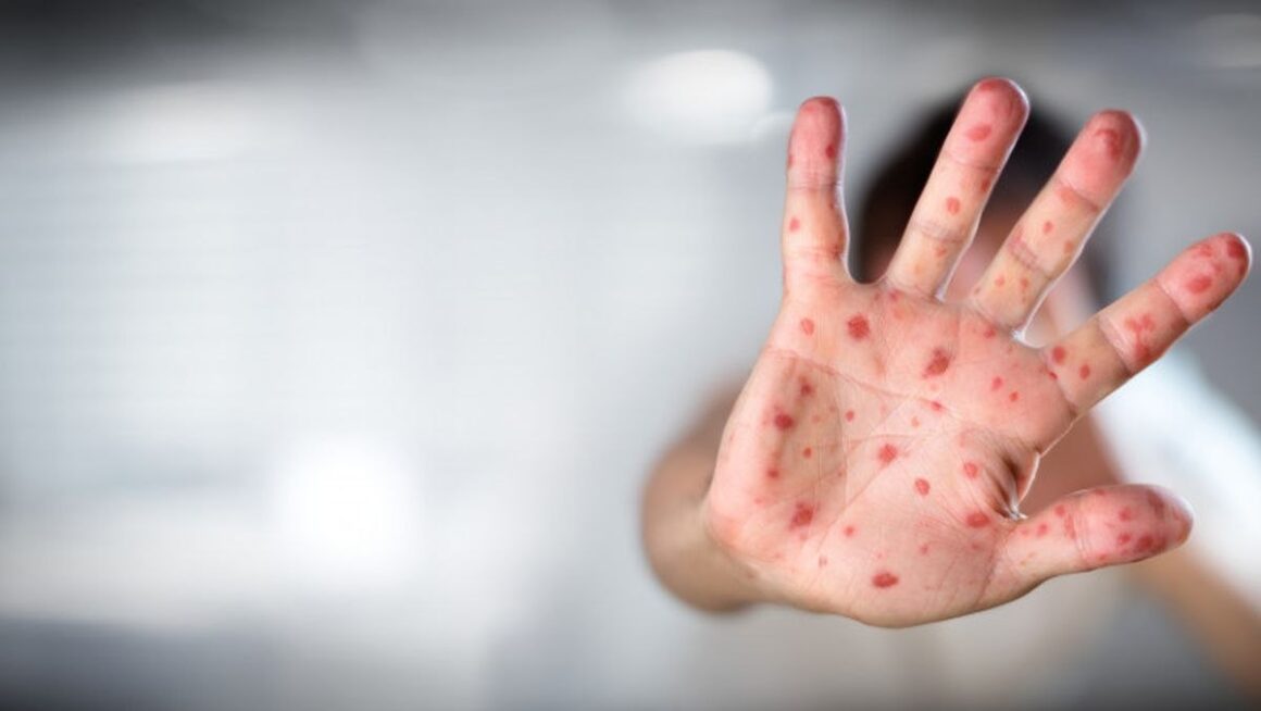 1702705226_index.jpeg Rujeola a făcut două victime: un copil de 7 luni și o femeie de 53 de ani. Peste 500 de cazuri noi în ultima săptămână