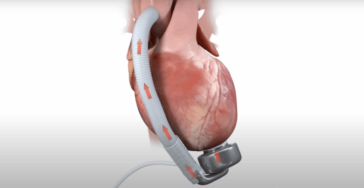pompa.png Prima pompă cardiacă cu membrană ondulată a fost implantată