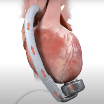 Prima pompă cardiacă cu membrană ondulată a fost implantată