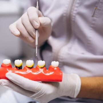 Poți beneficia de implant dentar dacă ai parodontoză?